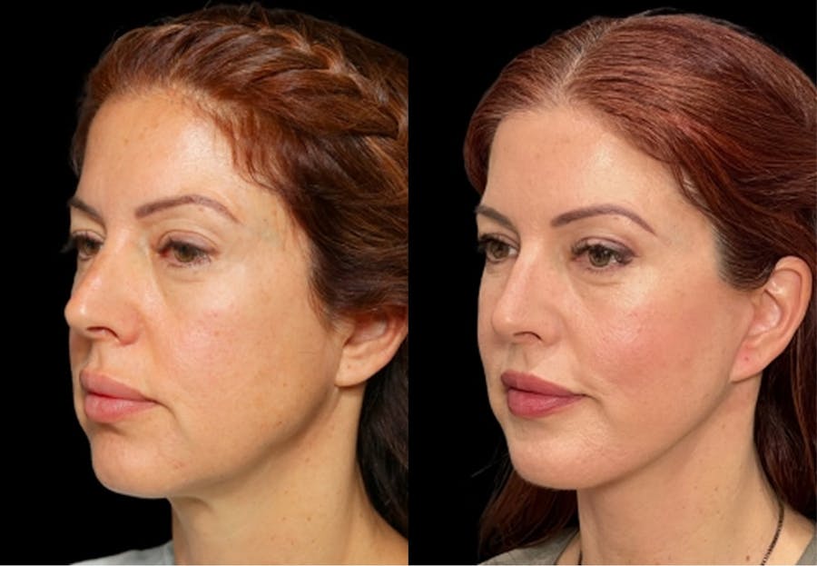 Facelift before and after patient result