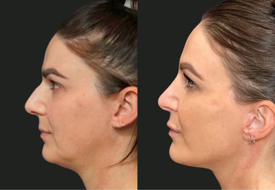 Facelift before and after patient result