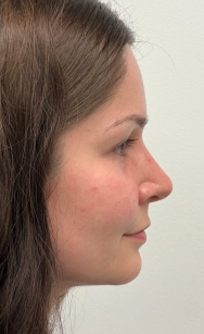 After image, case 2