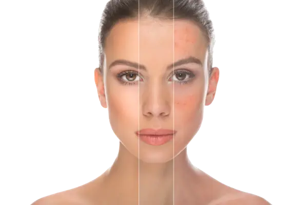 Naturopathic Acne Treatment FAQs - HealthBuddha